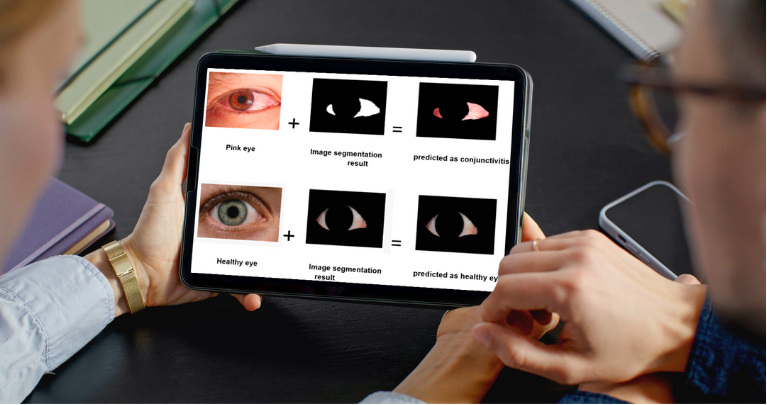 Conjunctivitis Detection Interface showing before and after analysis of eye images